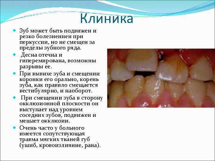 Клиника Зуб может быть подвижен и резко болезненнен при перкуссии, но не смещен за