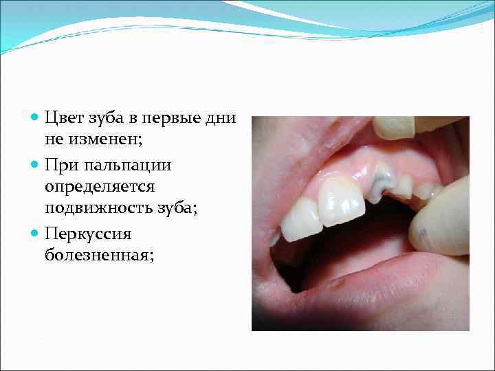  Цвет зуба в первые дни не изменен; При пальпации определяется подвижность зуба; Перкуссия