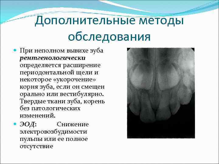 Дополнительные методы обследования При неполном вывихе зуба рентгенологически определяется расширение периодонтальной щели и некоторое
