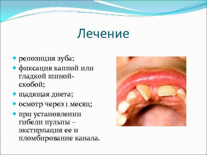 Лечение репозиция зуба; фиксация каппой или гладкой шинойскобой; щадящая диета; осмотр через 1 месяц;