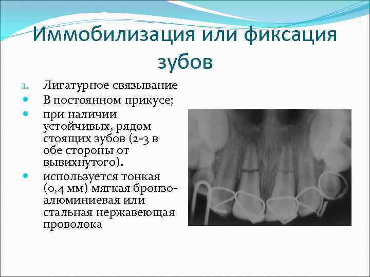 Иммобилизация или фиксация зубов 1. Лигатурное связывание В постоянном прикусе; при наличии устойчивых, рядом