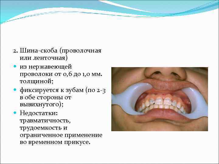 2. Шина-скоба (проволочная или ленточная) из нержавеющей проволоки от 0, 6 до 1, 0