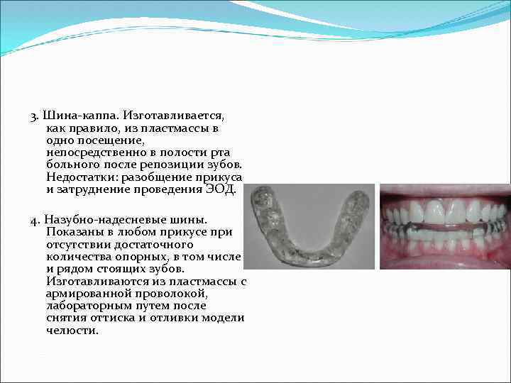 3. Шина-каппа. Изготавливается, как правило, из пластмассы в одно посещение, непосредственно в полости рта
