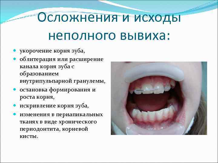 Осложнения и исходы неполного вывиха: укорочение корня зуба, облитерация или расширение канала корня зуба