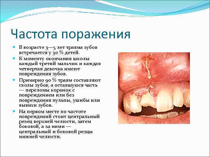 Травмы зубов у детей презентация