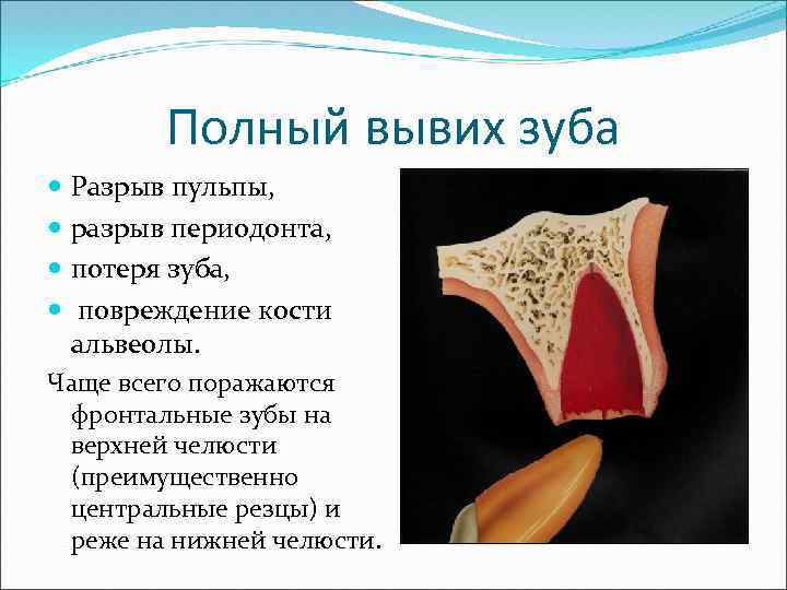 Полный вывих зуба Разрыв пульпы, разрыв периодонта, потеря зуба, повреждение кости альвеолы. Чаще всего