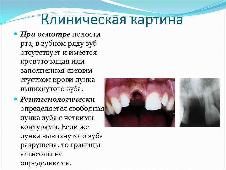 Клиническая картина При осмотре полости рта, в зубном ряду зуб отсутствует и имеется кровоточащая