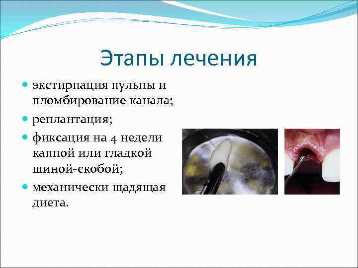 Этапы лечения экстирпация пульпы и пломбирование канала; реплантация; фиксация на 4 недели каппой или