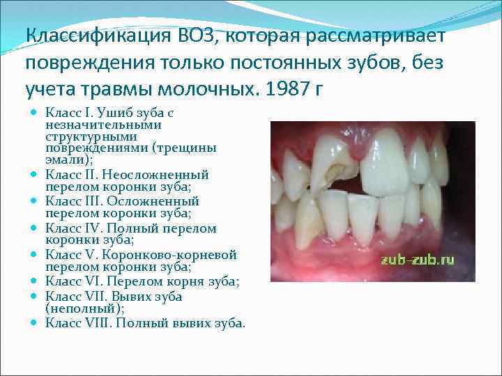 Классификация ВОЗ, которая рассматривает повреждения только постоянных зубов, без учета травмы молочных. 1987 г