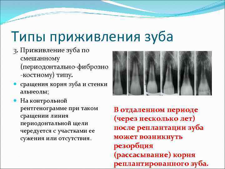 Типы приживления зуба 3. Приживление зуба по смешанному (периодонтально-фиброзно -костному) типу. сращения корня зуба