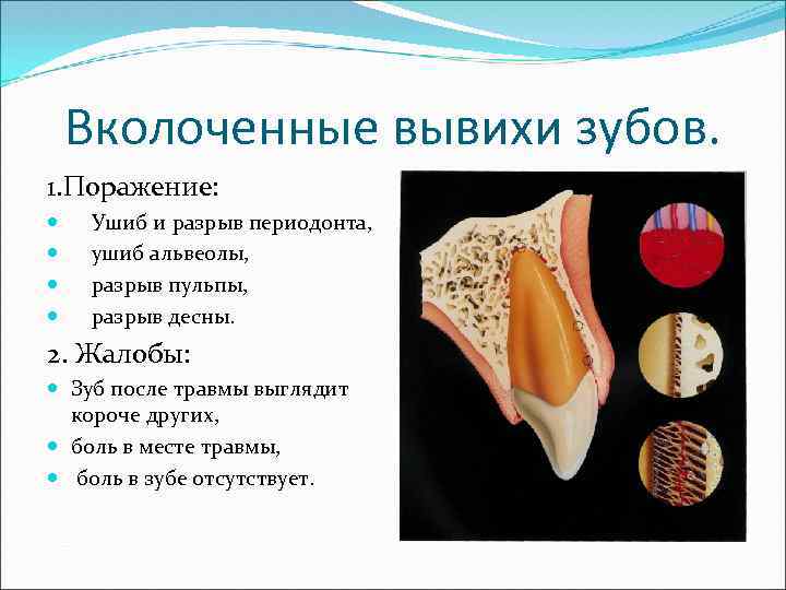 Вколоченные вывихи зубов. 1. Поражение: Ушиб и разрыв периодонта, ушиб альвеолы, разрыв пульпы, разрыв