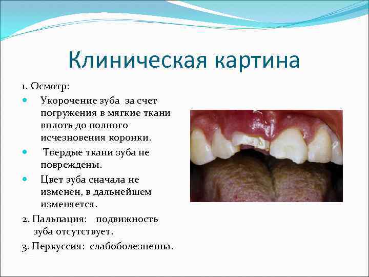 Клиническая картина 1. Осмотр: Укорочение зуба за счет погружения в мягкие ткани вплоть до