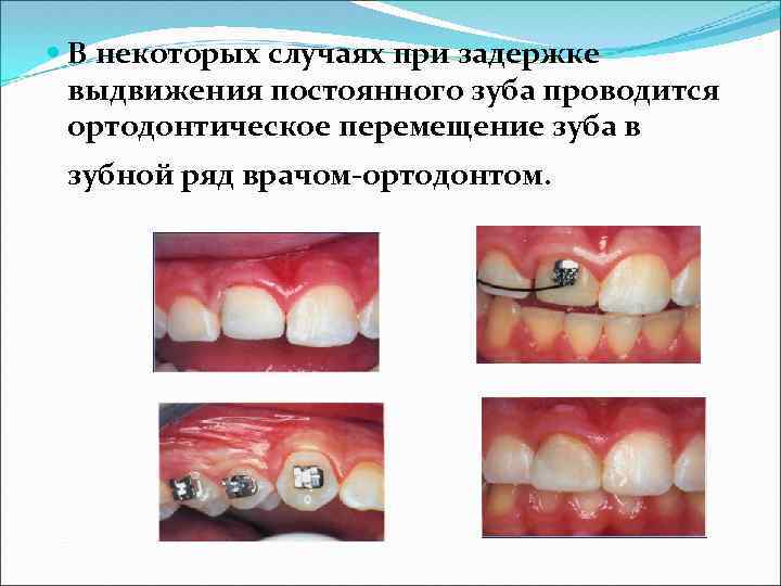  В некоторых случаях при задержке выдвижения постоянного зуба проводится ортодонтическое перемещение зуба в