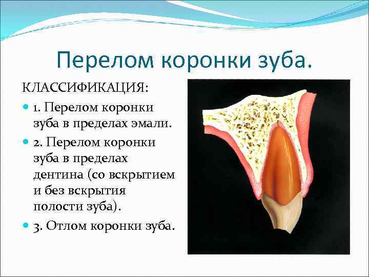 Перелом коронки зуба. КЛАССИФИКАЦИЯ: 1. Перелом коронки зуба в пределах эмали. 2. Перелом коронки