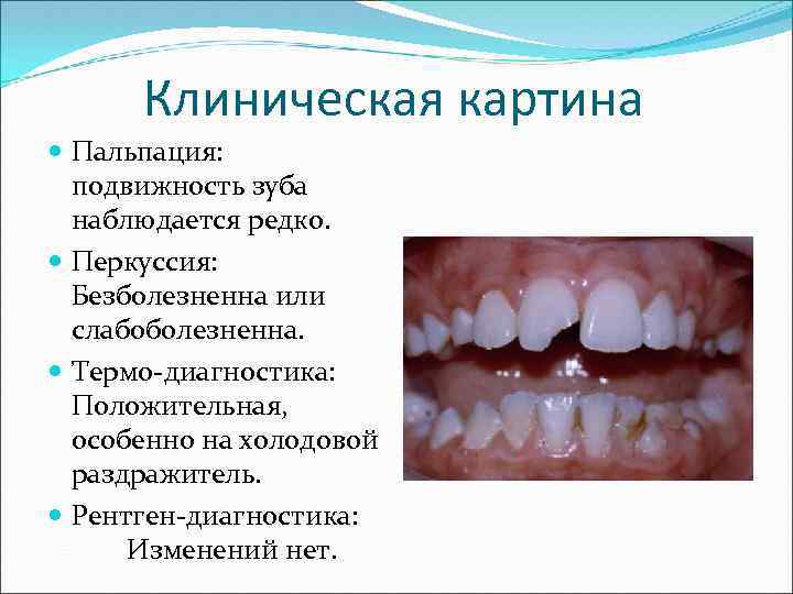 Клиническая картина Пальпация: подвижность зуба наблюдается редко. Перкуссия: Безболезненна или слабоболезненна. Термо-диагностика: Положительная, особенно
