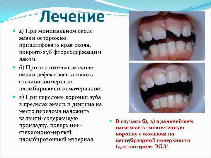 Лечение а) При минимальном сколе эмали осторожно пришлифовать края скола, покрыть зуб фторсодержащим лаком.