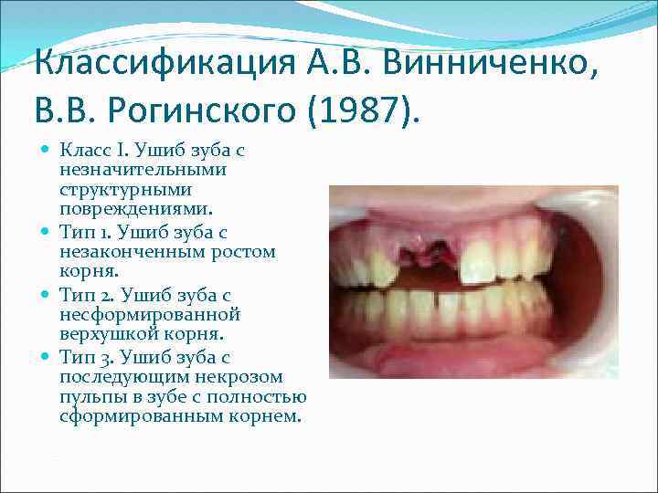 Классификация А. В. Винниченко, В. В. Рогинского (1987). Класс I. Ушиб зуба с незначительными