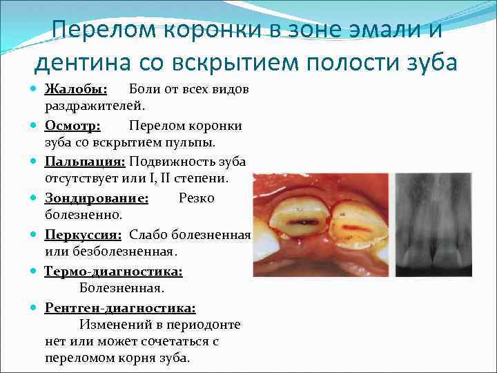 Перелом коронки в зоне эмали и дентина со вскрытием полости зуба Жалобы: Боли от