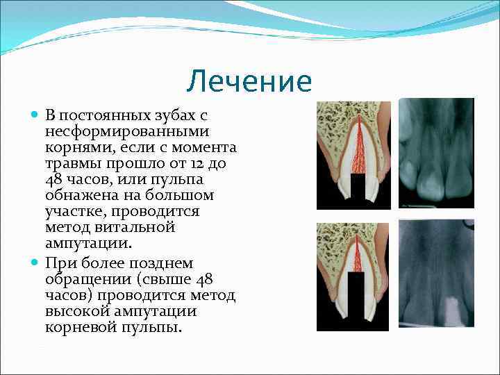 Апексогенез и апексификация презентация