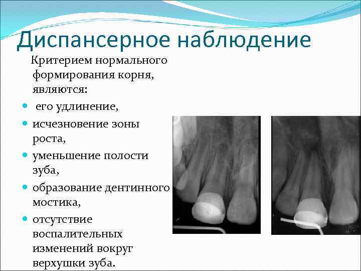 Диспансерное наблюдение Критерием нормального формирования корня, являются: его удлинение, исчезновение зоны роста, уменьшение полости