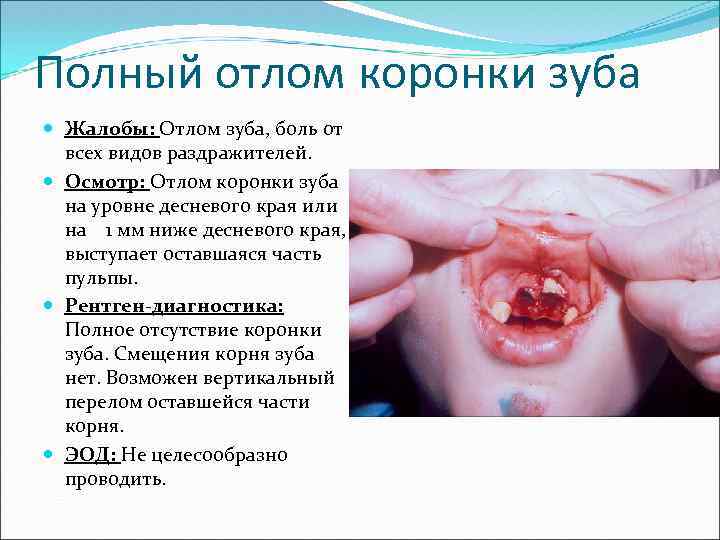 Полный отлом коронки зуба Жалобы: Отлом зуба, боль от всех видов раздражителей. Осмотр: Отлом