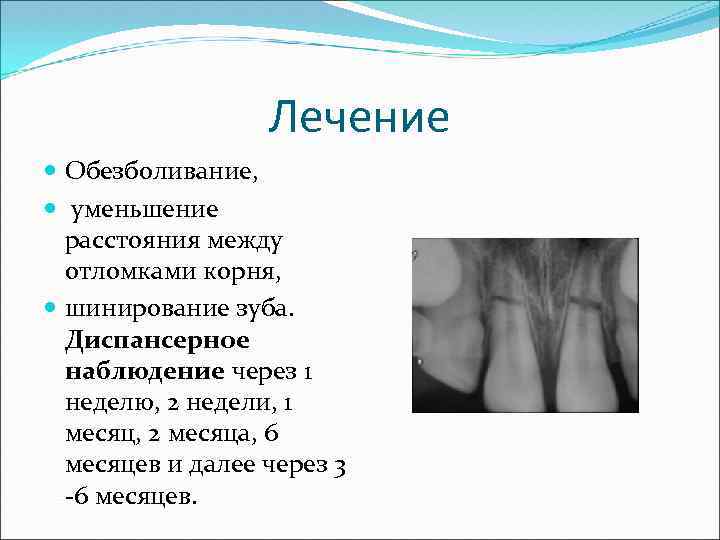 Лечение Обезболивание, уменьшение расстояния между отломками корня, шинирование зуба. Диспансерное наблюдение через 1 неделю,