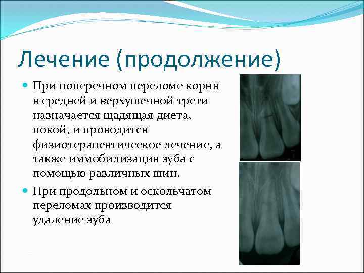Лечение (продолжение) При поперечном переломе корня в средней и верхушечной трети назначается щадящая диета,