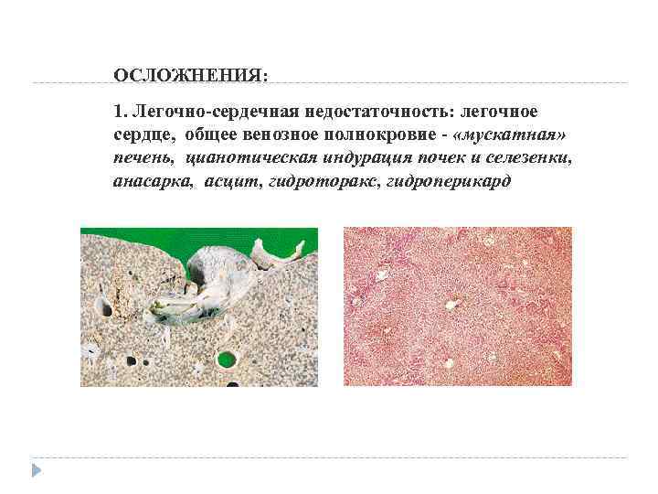ОСЛОЖНЕНИЯ: 1. Легочно-сердечная недостаточность: легочное сердце, общее венозное полнокровие - «мускатная» печень, цианотическая индурация