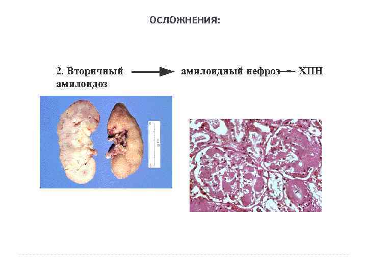 ОСЛОЖНЕНИЯ: 2. Вторичный амилоидоз амилоидный нефроз ХПН 