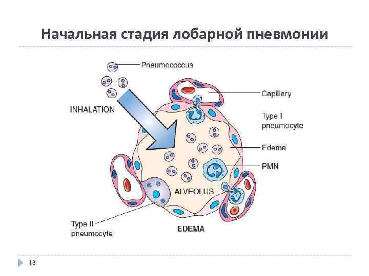 Начальная стадия лобарной пневмонии 13 