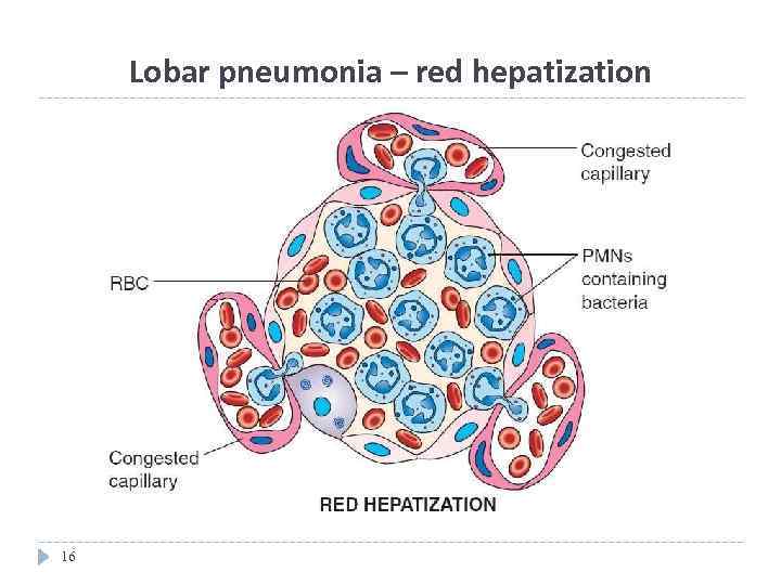 Lobar pneumonia – red hepatization 16 