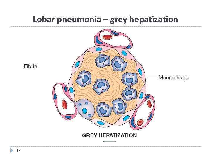 Lobar pneumonia – grey hepatization 19 