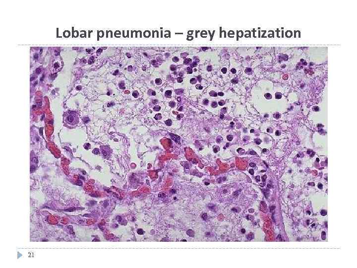 Lobar pneumonia – grey hepatization 21 