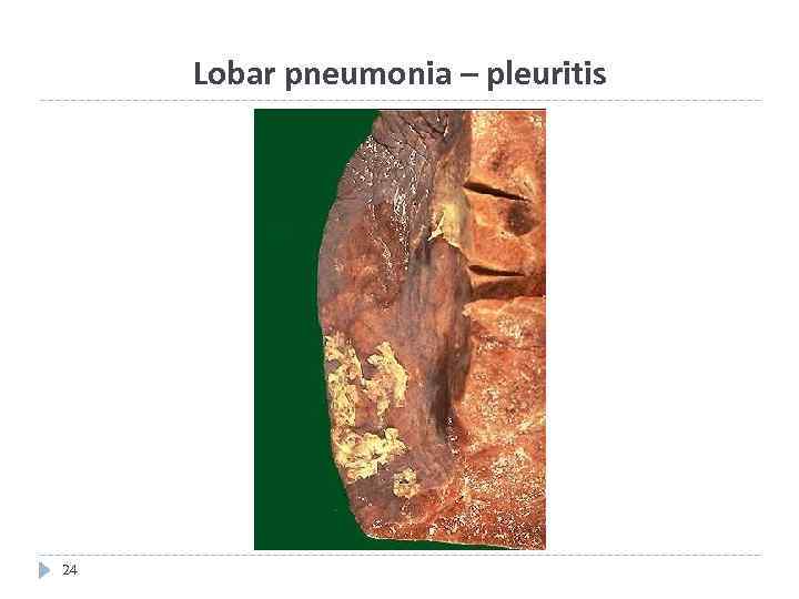 Lobar pneumonia – pleuritis 24 