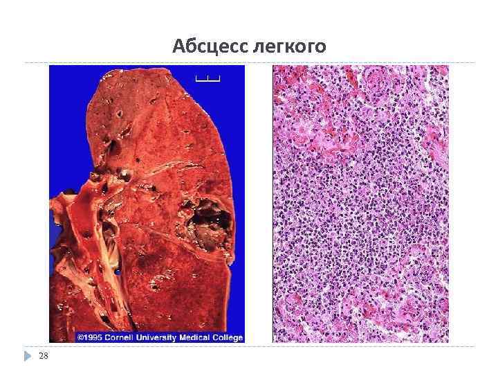 Абсцесс легкого 28 