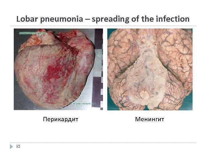 Lobar pneumonia – spreading of the infection Перикардит 32 Менингит 