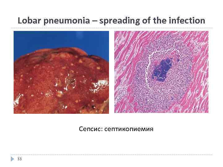 Lobar pneumonia – spreading of the infection Сепсис: септикопиемия 33 