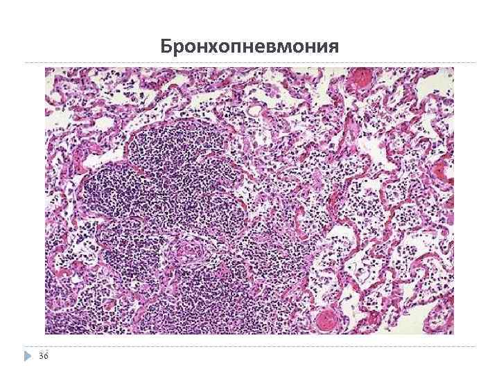Бронхопневмония 36 