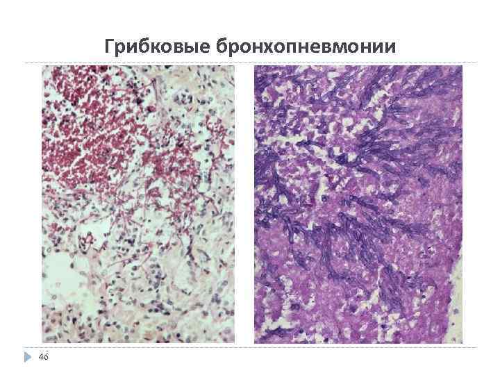 Грибковые бронхопневмонии 46 