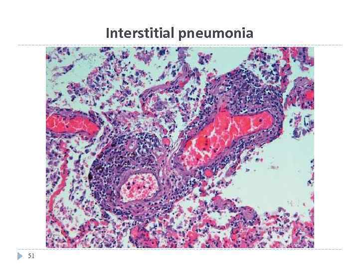 Interstitial pneumonia 51 