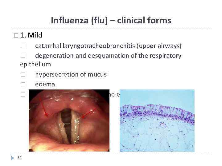 Influenza (flu) – clinical forms 1. Mild catarrhal laryngotracheobronchitis (upper airways) degeneration and desquamation