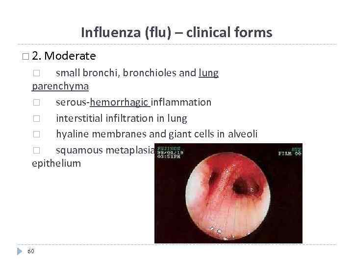 Influenza (flu) – clinical forms 2. Moderate small bronchi, bronchioles and lung parenchyma serous-hemorrhagic