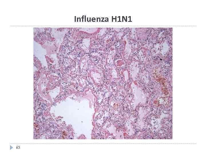 Influenza H 1 N 1 65 