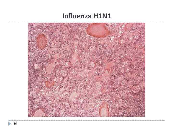 Influenza H 1 N 1 66 