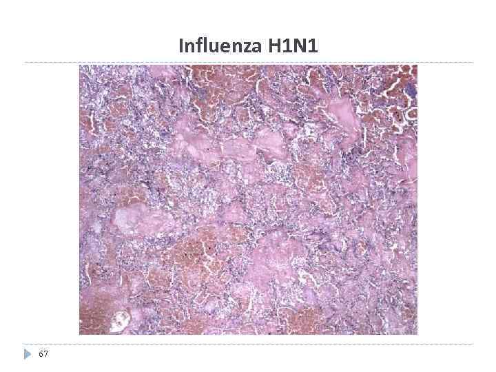 Influenza H 1 N 1 67 