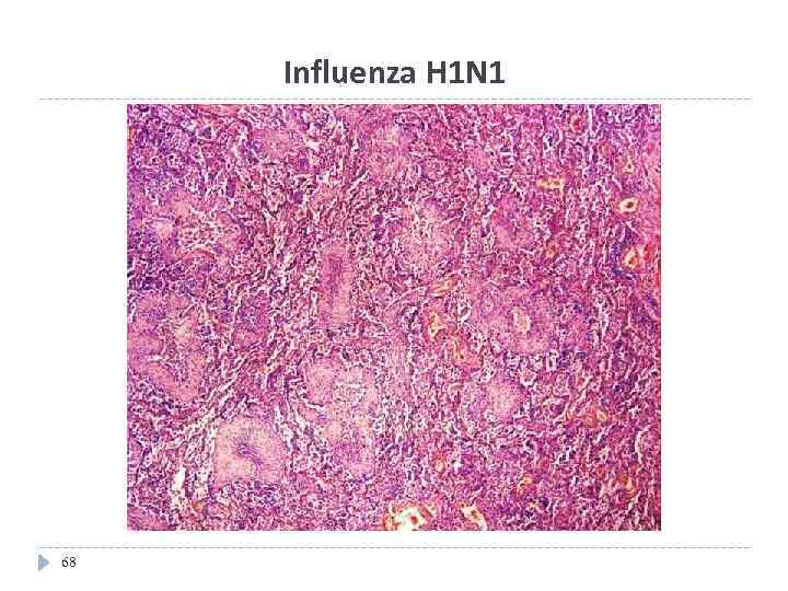 Influenza H 1 N 1 68 
