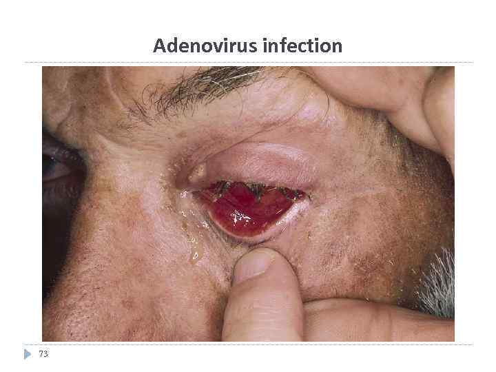 Adenovirus infection 73 