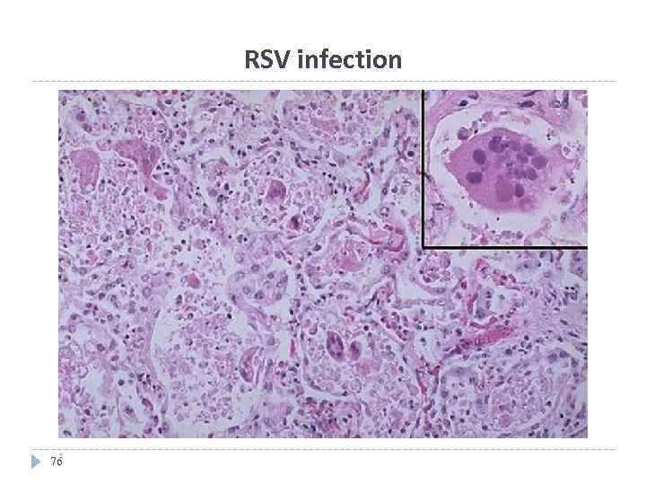 RSV infection 76 
