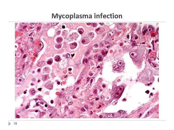 Mycoplasma infection 79 
