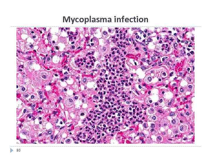 Mycoplasma infection 80 